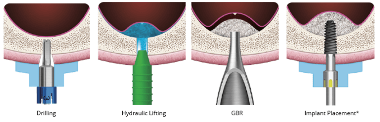 hiossen crestal approach sinus lift procedure steps