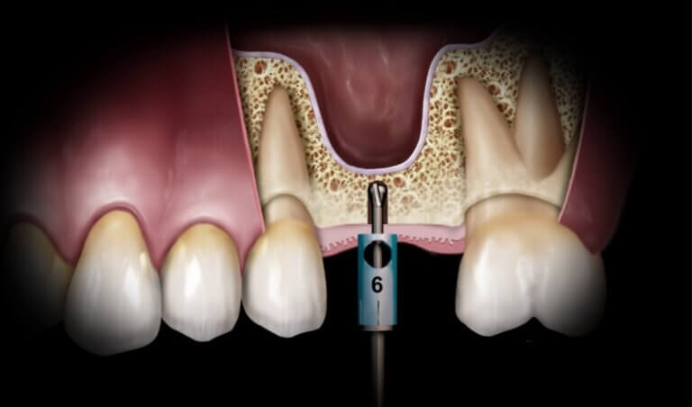 Hiossen crestal approach sinus lift procedure Toronto