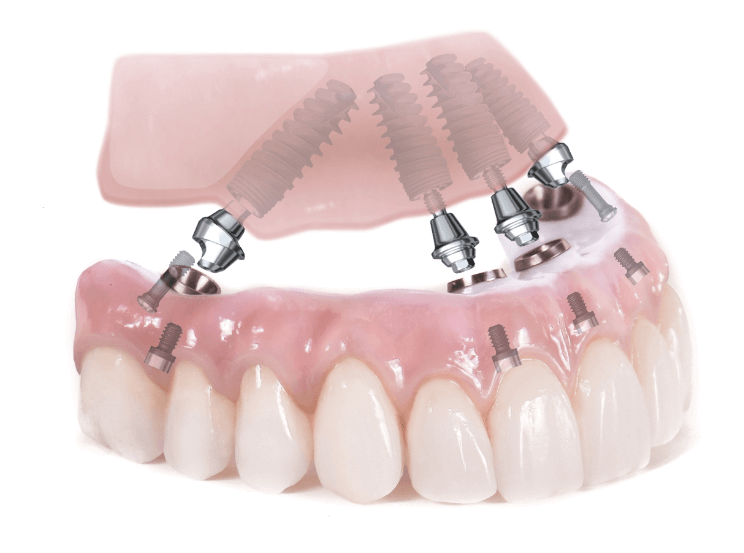 Teeth In A Day Dental Implants Toronto