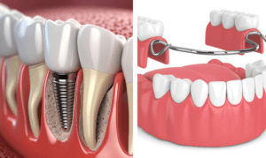 Dental implants vs Dentures in Toronto