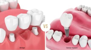 Dental Implant vs Dental Bridge: pros, cons and costs