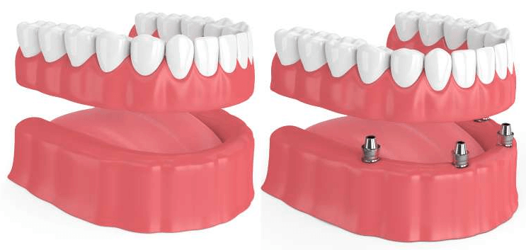 Dentures vs implant dentures