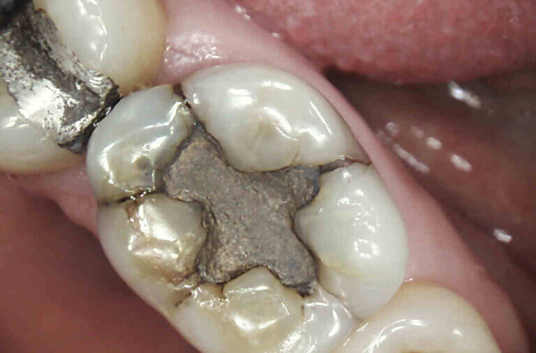 Mercury amalgam fillings