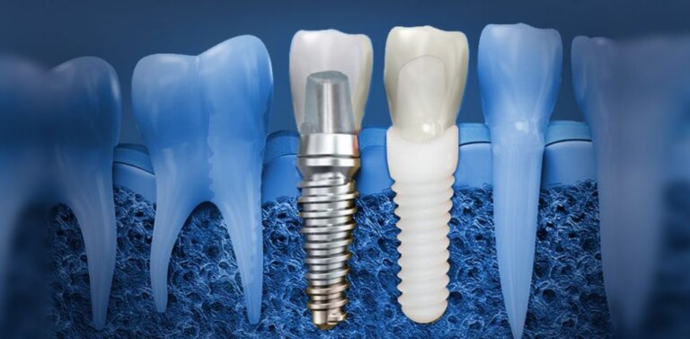 Zirconia vs Titanium dental implants